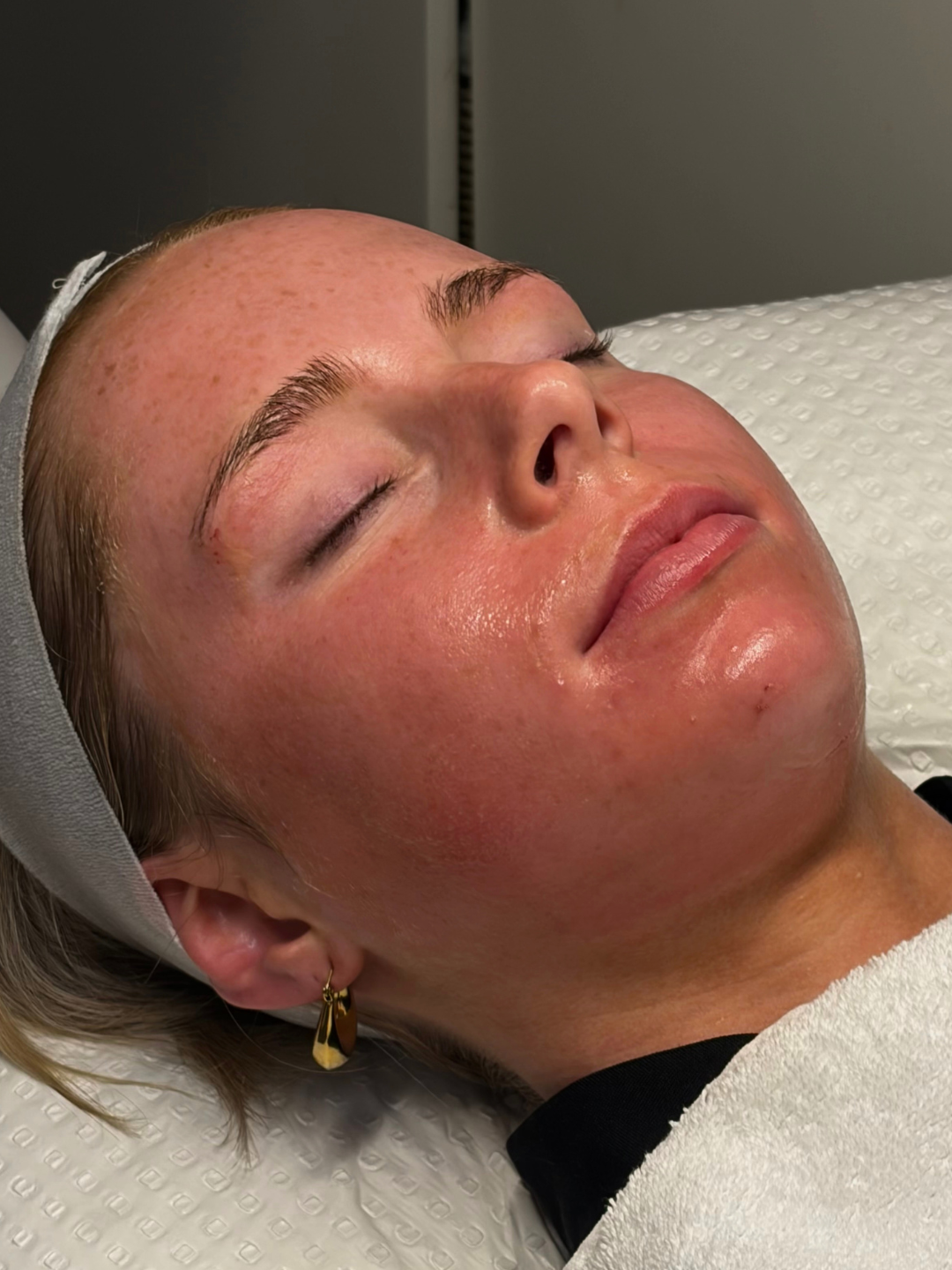Real client results from a Skin Secrets treatment